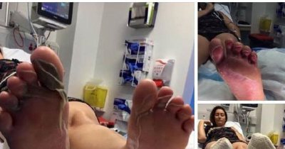 25 Year Old Woman Gets Insane Blisters After Running Across Perth Beach Without Shoes
