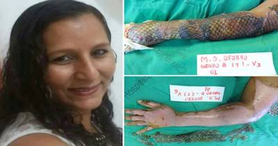 Doctors Use Fish Scales To Treat Woman&rsquo;s Burned Body
