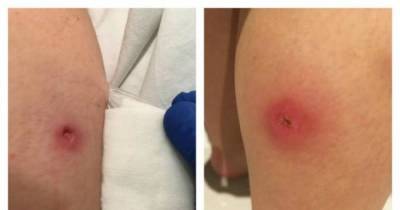 She Thought Her Daughter Got A Mosquito Bite, But It Was Much More Dangerous