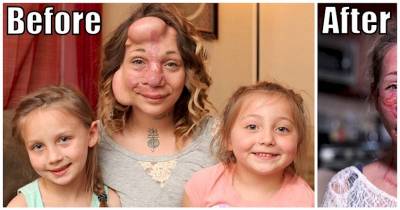 Woman Forced To Have Balloons Under Her Skin Looks Totally Different After Surgery