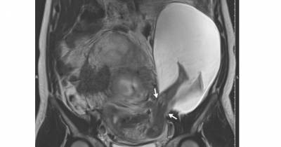 Strange Sight: Baby's Feet Sticking Out Of Uterus