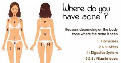The Location Of Body Acne Can Explain The REAL Reason Why You Break Out.