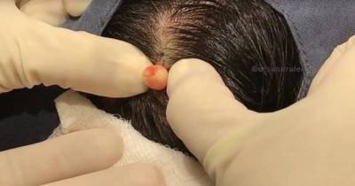 Most DISGUSTING Dr Pimple Popper Video Yet Shows Huge Puss-Filled Cyst Ball Being Popped Out Of Patient's Head