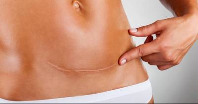4 Truths About C-Section Mothers That Everyone Should Know