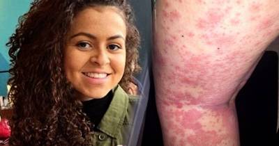 She Thought They Were Razor Burns, They Were Actually Something Much Scarier!