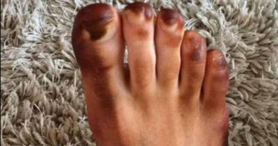 He Woke Up With A Brown Foot And Immediately Freaked Out But His Girlfriend Knew What To Do.