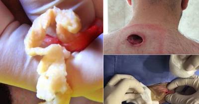 Guy Saw A Massive Lump Under His Skin And Was Terrified By What Came Out Of It