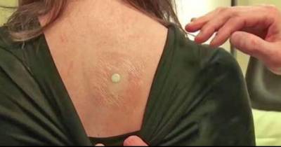 Doctor Tapes A Watch Battery To Her Back. When He Peels It Off? She Had No Idea!