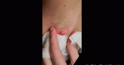 This Woman Had A 20-year-old Egg-sized Cyst Under Her Armpit And When It Popped Out... Omg!