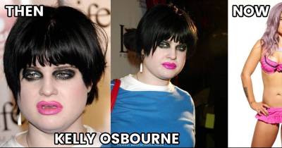 Celebrities Who Actually Improved With Plastic Surgery