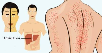 8 Signals Your Body Gives You When Your Liver Is Being Damaged