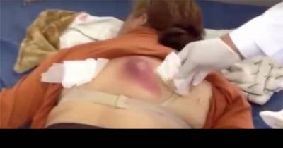 A Lump On Her Body Started To Turn Black Then The Doctors Put Pressure On It