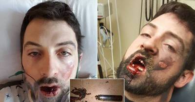 Idaho Father, 30, Loses Seven Teeth And Is Left With Second Degree Burns After Vape Explodes In His Face