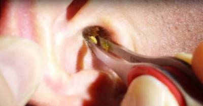 She Was Tired Of The Constant Discomfort, Grabs A Pair Of Tweezers And Yanks Hard