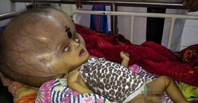 Boy With &lsquo;The World&rsquo;s Largest Head&rsquo; Has Surgery To Remove 3.7 Litres Of Fluid From Around His Skull