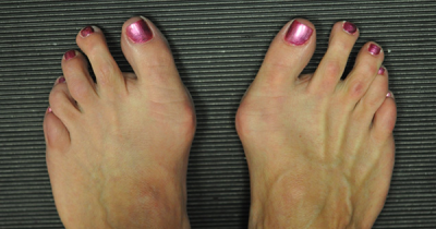 60% Of Women Have Bunions But Doing This Could Prevent Expensive Surgery