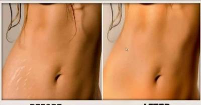 How To Get Rid Of Stretch Marks