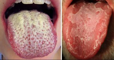 Here&rsquo;s Why You Have A White Tongue & How To Fix It!