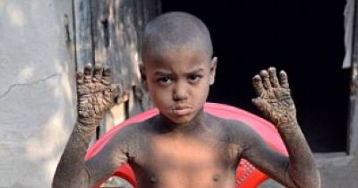 Meet The 8 Year-Old Boy Who Is Turning Into Stone Because Of This Rare Condition.