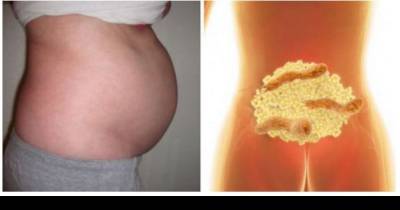 This Is Why You Have Bloated Stomach And How To Get Rid Of Bloating And Lose Weight Overnight!