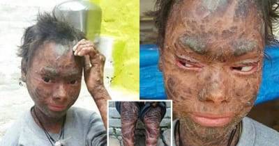 The Human Snake: Girl, 16, Sheds Her Skin Every Six Weeks