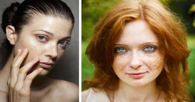 The Truth About Freckles