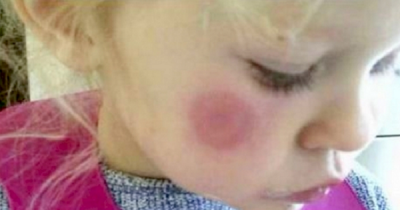 Mom Saw This Deadly Spot On Her Daughter's Face, And Is Now Warning Others