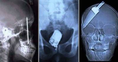 22 Strange Objects Found In X-Rays And The Shocking Stories Behind Them