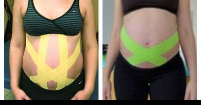 Expecting Moms: Try This Kinesiology Tape Trick For Drug-Free Pain Relief