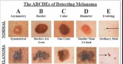 This Is How You Can Recognise Skin Cancer