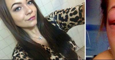 This Teenager Almost Went Blind From Simply Dyeing Her Eyebrows