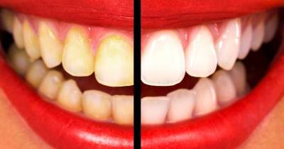 9 Tips For A Perfect Hollywood Smile