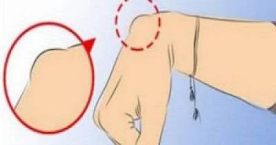 If You Have This On Your Wrist, Stop Whatever You Are Doing And Immediately Visit Your Doctor!
