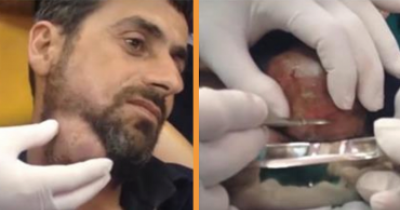 Surgeon Pops Huge Abscess On Man&rsquo;s Neck And It Is Pure Pus Heaven