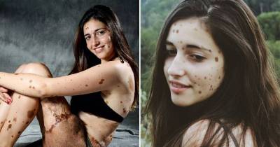 This Teen Was Called A Monster Because Of Her 500 Birthmarks. But Now She&rsquo;s The One Who&rsquo;s Smiling
