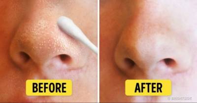 9 Natural Ways To Get Rid Of Blackheads And Whiteheads Fast