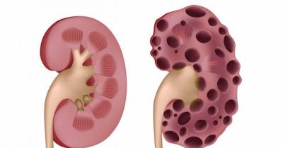 10 Habits That Will Seriously Damage Your Kidneys