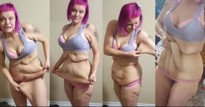 Woman Lost 186 Pounds And Is Desperate To Remove 'Apron' Of Excess Skin