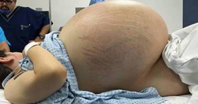 This Woman's Enormous Belly Left Everyone Astonished- What Doctors Saw On The X-Ray Is Unbelievable!