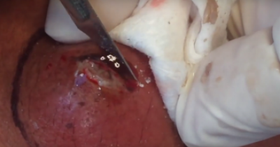 This Nasty Cyst Explodes Like A Volcano Of Pus
