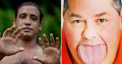These 10 People Have The Strangest Real-Life Mutations