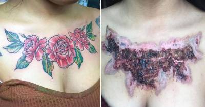 Woman Enjoys Her Tattoo Until It Falls Off And Takes Her Skin With It!