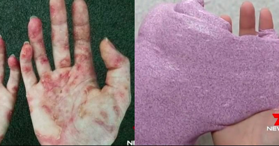 Teenager Suffers Chemical Burns From Homemade Slime