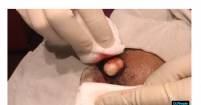 Dr. Pimple Popper Pops Out A 'Matzo Ball' Cyst From Her Patient's Forehead.