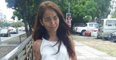 Woman Who Was Called A Monster For Her Head-To-Toe Hairy Moles Might Be The Next Miss Universe