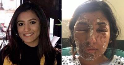 Woman Severely Burned In Acid Attack On 21st Birthday