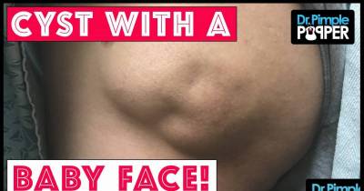 This Dr. Pimple Popper Video Of A 50-Year-Old Cyst Shaped Like A Baby's Face Might Be Too Much For Even Her Most Hardcore Fans.