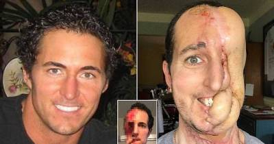 Man Who Lost Half His Face Due To Cancer Is Undergoing Drastic Surgery!