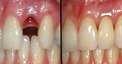 Who Needs False Teeth! This New Dental Technology Allows You To Grow A New Tooth In Just 9 Weeks