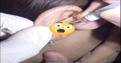 Gut-Churning Video Shows Massive Clump Of Wax Pulled From Woman&rsquo;s Ear